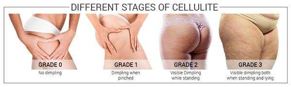 What is cellulite and how to minimise its appearance? - UpCircle